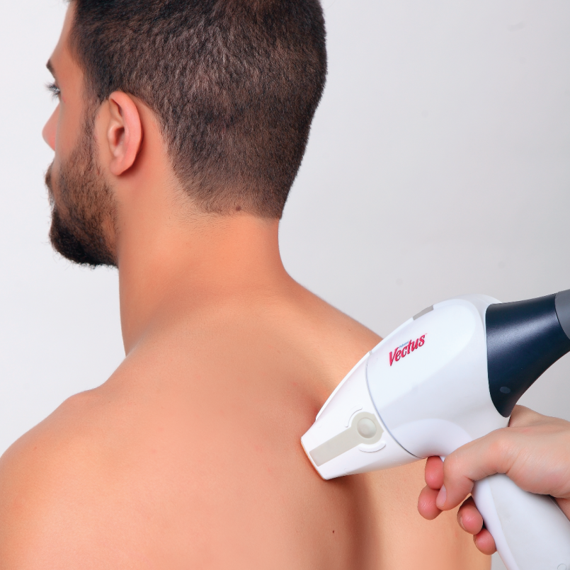 Cynosure Vectus and Light Sheer Laser Hair Removal