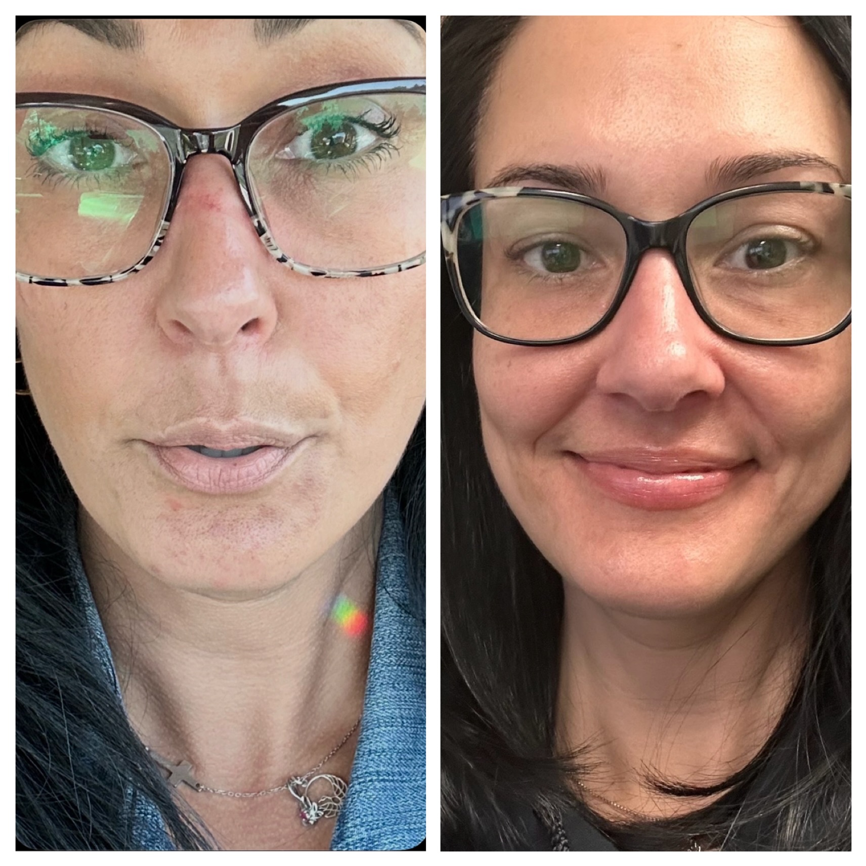 Peels in Plymouth, MI | PHR Centers - VI-peel