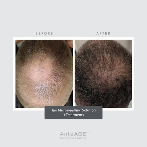 Hair Restoration - PHR Laser Centers - hair-restoration