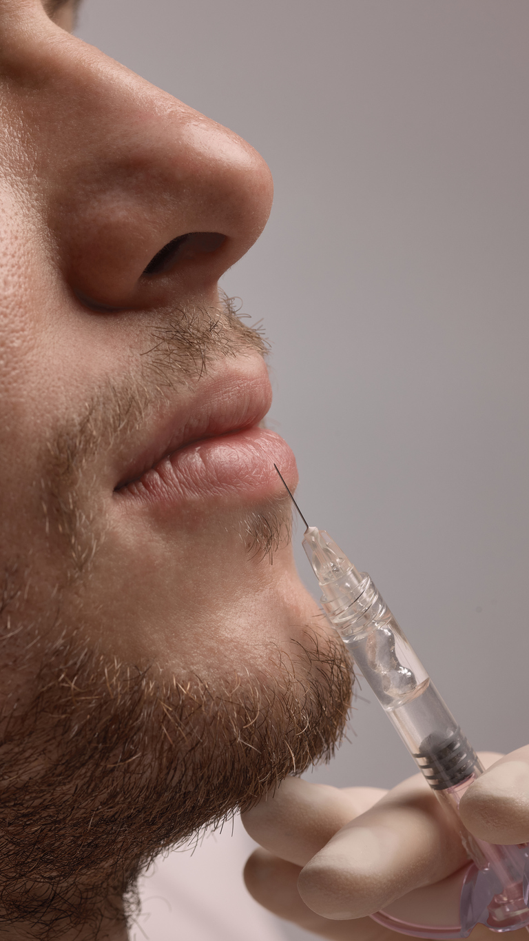 What to Expect During Natural Lip Filler Treatment