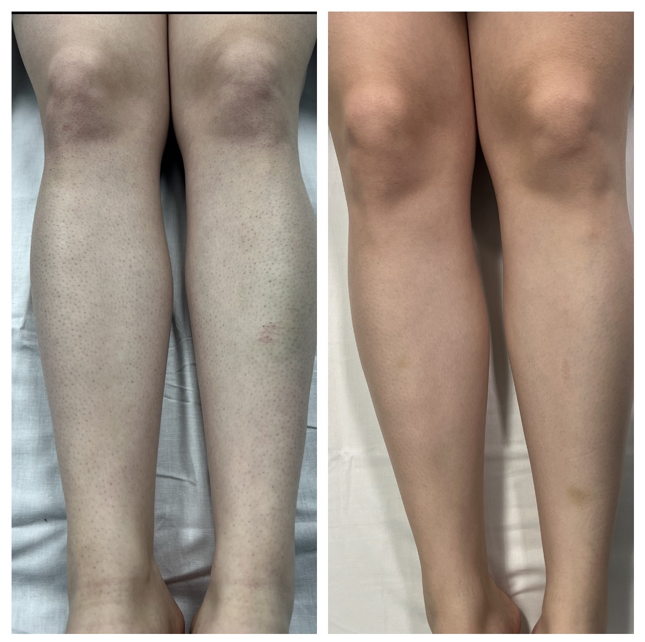 Entire Leg hair Removal in plymouth mi