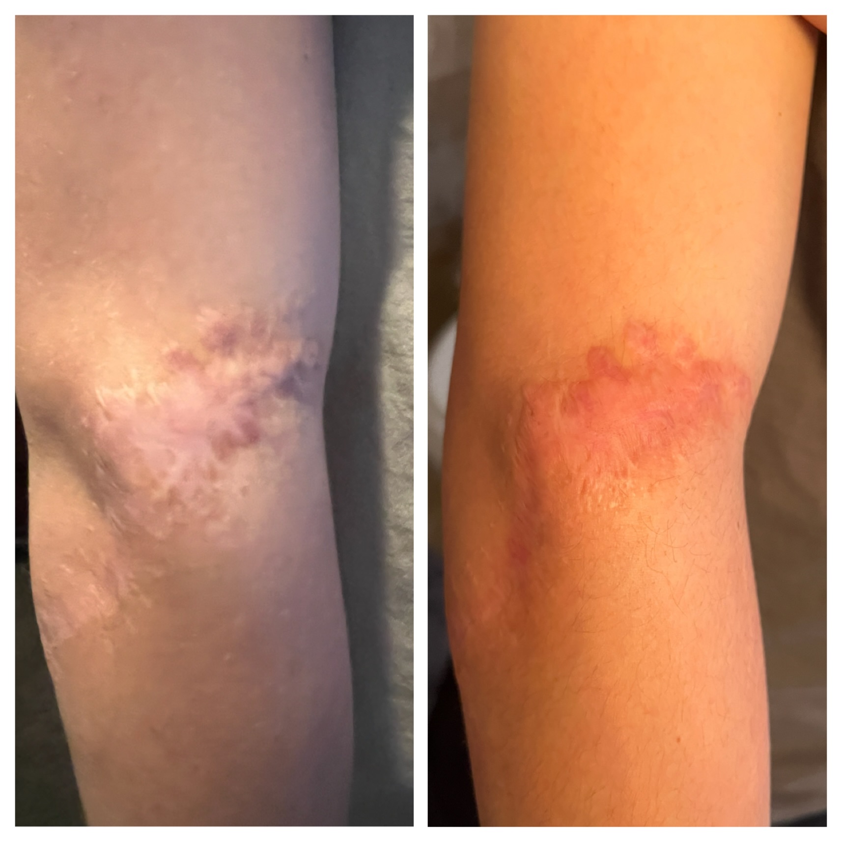 Microneedling in Plymouth, MI | PHR Centers - microneedling-scar-arm